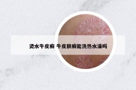 燙水牛皮癬 牛皮膚癬能洗熱水澡嗎