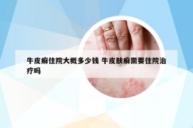 牛皮癬住院大概多少錢 牛皮膚癬需要住院治療嗎