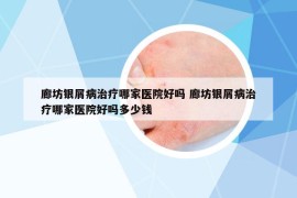 廊坊銀屑病治療哪家醫(yī)院好嗎 廊坊銀屑病治療哪家醫(yī)院好嗎多少錢