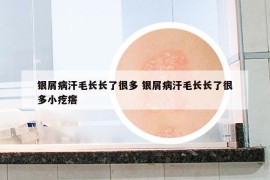 銀屑病汗毛長長了很多 銀屑病汗毛長長了很多小疙瘩