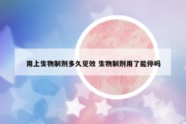 用上生物制劑多久見效 生物制劑用了能停嗎