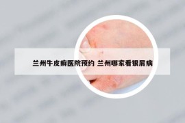 蘭州牛皮癬醫(yī)院預(yù)約 蘭州哪家看銀屑病