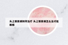 頭上銀屑病如何治療 頭上銀屑病怎么治才能斷根