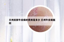 蘭州皮膚牛皮癬的費用是多少 蘭州牛皮癬醫(yī)院