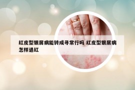 紅皮型銀屑病能轉(zhuǎn)成尋常行嗎 紅皮型銀屑病怎樣退紅