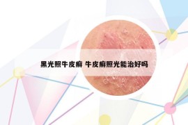 黑光照牛皮癬 牛皮癬照光能治好嗎
