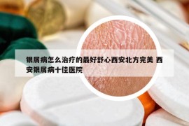 銀屑病怎么治療的最好舒心西安北方完美 西安銀屑病十佳醫(yī)院