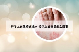 脖子上有像癬還流水 脖子上出癬是怎么回事