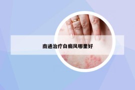 南通治療白癜風哪里好
