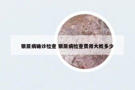 銀屑病確診檢查 銀屑病檢查費(fèi)用大概多少