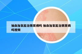 抽血加氧能治銀屑病嗎 抽血加氧能治銀屑病嗎視頻