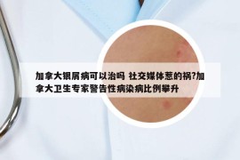 加拿大銀屑病可以治嗎 社交媒體惹的禍?加拿大衛(wèi)生專家警告性病染病比例攀升