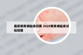 最新銀屑病臨床招募 2020銀屑病臨床試驗(yàn)招募