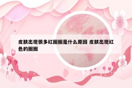 皮膚出現(xiàn)很多紅圈圈是什么原因 皮膚出現(xiàn)紅色的圈圈