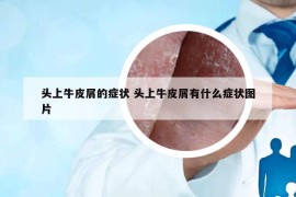 頭上牛皮屑的癥狀 頭上牛皮屑有什么癥狀圖片