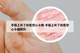 手指上長(zhǎng)了白色空心小圈 手指上長(zhǎng)了白色空心小圈照片