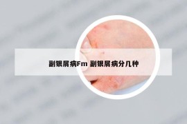 副銀屑病Fm 副銀屑病分幾種
