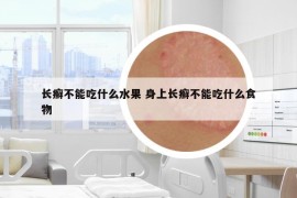 長(zhǎng)癬不能吃什么水果 身上長(zhǎng)癬不能吃什么食物