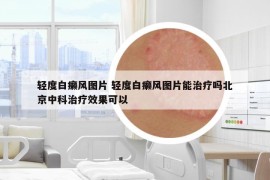 輕度白癩風圖片 輕度白癩風圖片能治療嗎北京中科治療效果可以