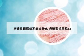 點(diǎn)滴性銀屑病不能吃什么 點(diǎn)滴型銀屑忌口