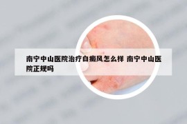 南寧中山醫(yī)院治療白癜風怎么樣 南寧中山醫(yī)院正規(guī)嗎