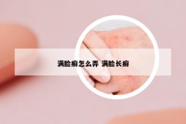 滿臉癬怎么弄 滿臉長癬