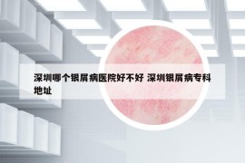 深圳哪個銀屑病醫(yī)院好不好 深圳銀屑病?？频刂? /></a>		
		</figure>

		<header class=