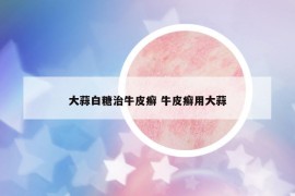 大蒜白糖治牛皮癬 牛皮癬用大蒜