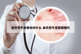 血熱型牛皮癬也叫什么 血熱型牛皮膚癬圖片