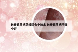 長春銀屑病正規(guī)適合中技術(shù) 長春銀屑病院哪個好