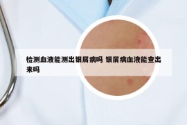檢測血液能測出銀屑病嗎 銀屑病血液能查出來嗎