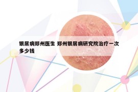 銀屑病鄭州醫(yī)生 鄭州銀屑病研究院治療一次多少錢