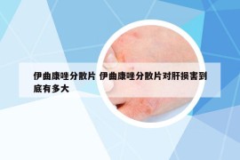 伊曲康唑分散片 伊曲康唑分散片對肝損害到底有多大