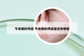 牛皮癬的傳染 牛皮癬的傳染途徑有哪些