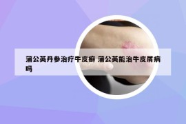 蒲公英丹參治療牛皮癬 蒲公英能治牛皮屑病嗎