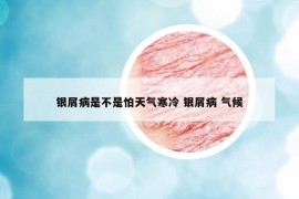 銀屑病是不是怕天氣寒冷 銀屑病 氣候