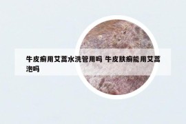 牛皮癬用艾蒿水洗管用嗎 牛皮膚癬能用艾蒿泡嗎