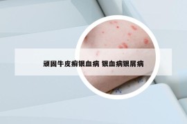 頑固牛皮癬銀血病 銀血病銀屑病
