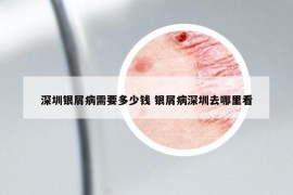 深圳銀屑病需要多少錢 銀屑病深圳去哪里看