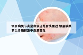 銀屑病關(guān)節(jié)炎是血液還是骨頭里過 銀屑病關(guān)節(jié)炎診斷標(biāo)準(zhǔn)中血液變化