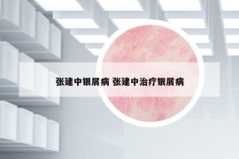 張建中銀屑病 張建中治療銀屑病