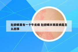 肚臍眼里有一個牛皮癬 肚臍眼長銀屑病是怎么回事