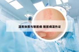 濕寒體質(zhì)與銀屑病 銀屑病濕熱證