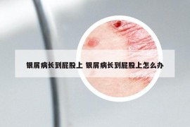 銀屑病長到屁股上 銀屑病長到屁股上怎么辦