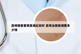 昆明哪里看銀屑病比較好 昆明治銀屑病要多少錢