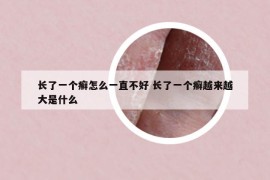 長(zhǎng)了一個(gè)癬怎么一直不好 長(zhǎng)了一個(gè)癬越來越大是什么