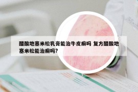 醋酸地塞米松乳膏能治牛皮癬嗎 復方醋酸地塞米松能治癬嗎?
