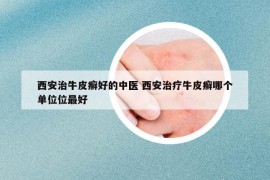 西安治牛皮癬好的中醫(yī) 西安治療牛皮癬哪個單位位最好
