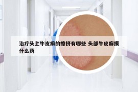 治療頭上牛皮癬的擦擠有哪些 頭部牛皮癬摸什么藥