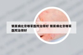 銀屑病北京哪家醫(yī)院治得好 銀屑病北京哪家醫(yī)院治得好